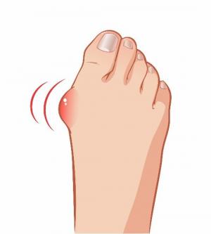 L'oignon du pied, appelé également Hallux Valgus traité en Ostéopathie à Viviers