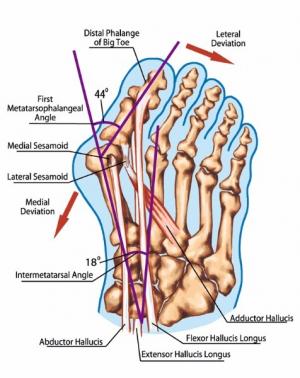 L'oignon du pied, appelé également Hallux Valgus traité en Ostéopathie à Viviers