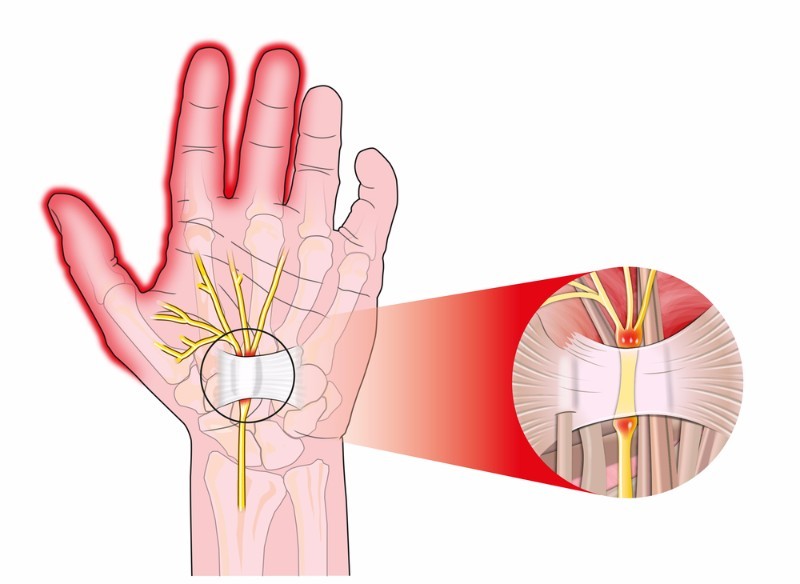 Syndrome canal carpien, douleurs poignets et mains, symptômes ...